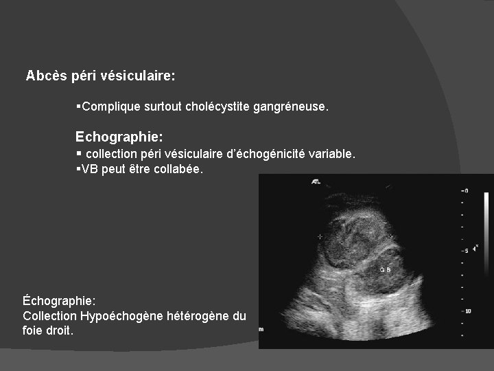 Abcès péri vésiculaire: §Complique surtout cholécystite gangréneuse. Echographie: § collection péri vésiculaire d’échogénicité variable.
