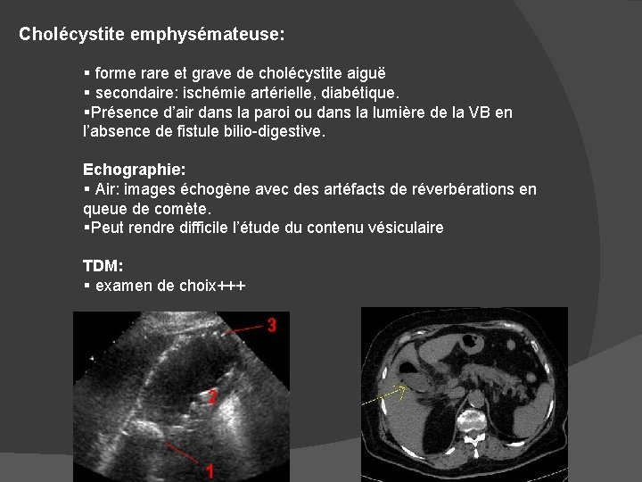 Cholécystite emphysémateuse: § forme rare et grave de cholécystite aiguë § secondaire: ischémie artérielle,