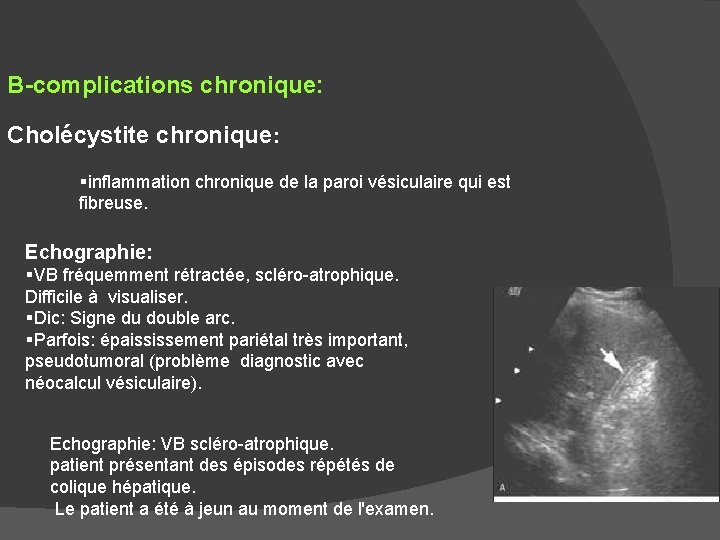 B-complications chronique: Cholécystite chronique: §inflammation chronique de la paroi vésiculaire qui est fibreuse. Echographie: