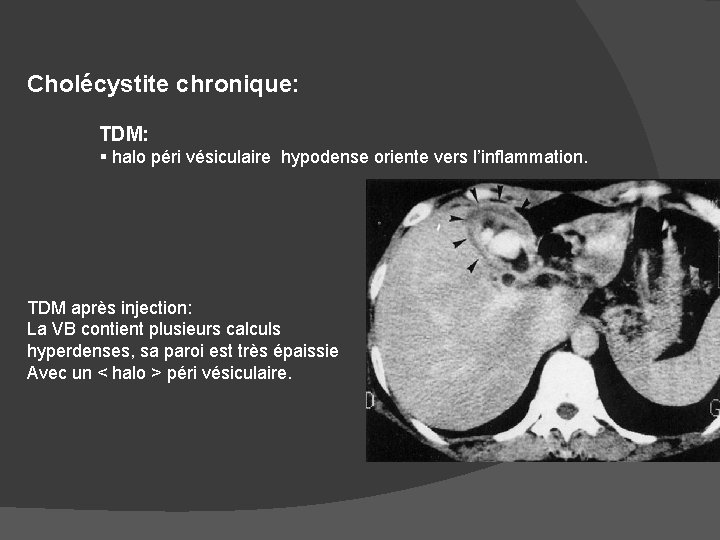 Cholécystite chronique: TDM: § halo péri vésiculaire hypodense oriente vers l’inflammation. TDM après injection:
