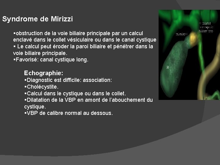 Syndrome de Mirizzi §obstruction de la voie biliaire principale par un calcul enclavé dans
