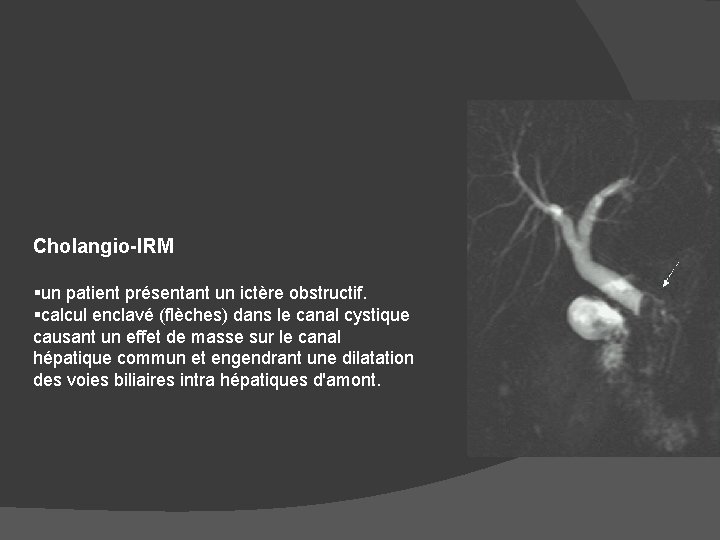 Cholangio-IRM §un patient présentant un ictère obstructif. §calcul enclavé (flèches) dans le canal cystique