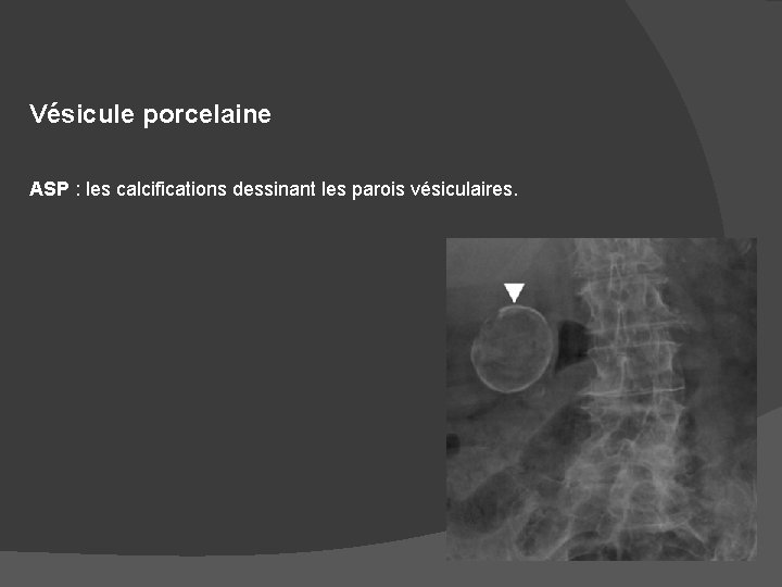 Vésicule porcelaine ASP : les calcifications dessinant les parois vésiculaires. 