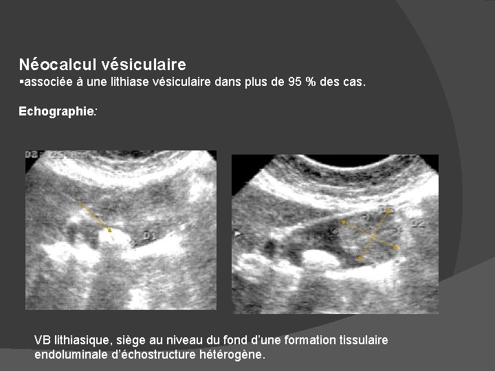 Néocalcul vésiculaire §associée à une lithiase vésiculaire dans plus de 95 % des cas.