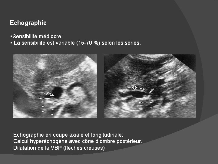 Echographie §Sensibilité médiocre. § La sensibilité est variable (15 -70 %) selon les séries.