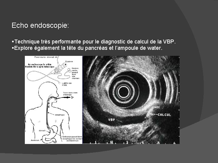 Echo endoscopie: §Technique très performante pour le diagnostic de calcul de la VBP. §Explore