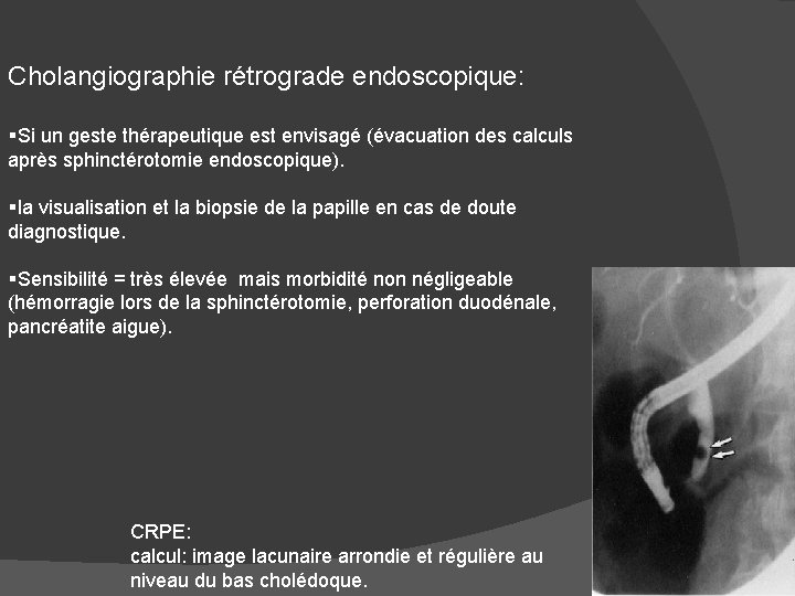 Cholangiographie rétrograde endoscopique: §Si un geste thérapeutique est envisagé (évacuation des calculs après sphinctérotomie