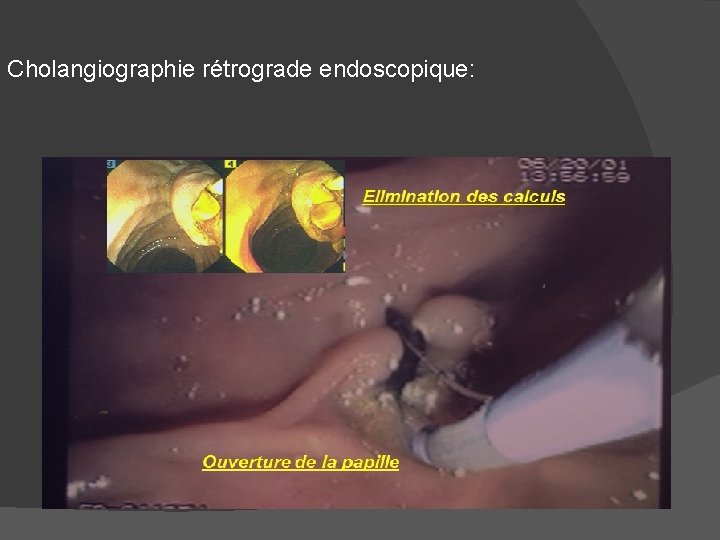 Cholangiographie rétrograde endoscopique: 