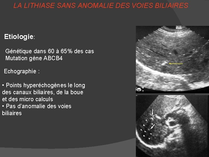 LA LITHIASE SANS ANOMALIE DES VOIES BILIAIRES Etiologie: Génétique dans 60 à 65% des