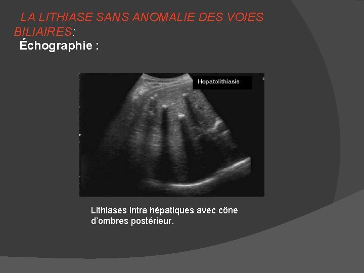 LA LITHIASE SANS ANOMALIE DES VOIES BILIAIRES: Échographie : Lithiases intra hépatiques avec cône