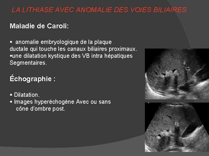 LA LITHIASE AVEC ANOMALIE DES VOIES BILIAIRES Maladie de Caroli: § anomalie embryologique de