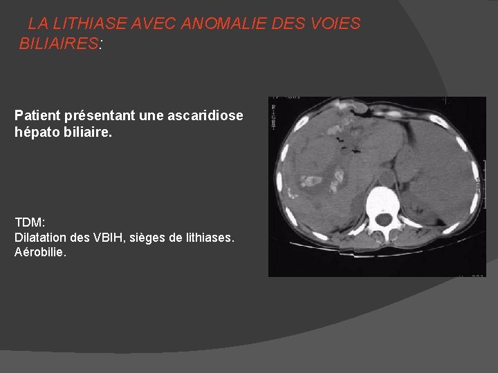 LA LITHIASE AVEC ANOMALIE DES VOIES BILIAIRES: Patient présentant une ascaridiose hépato biliaire. TDM: