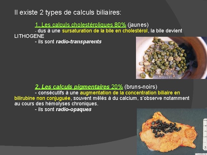 Il existe 2 types de calculs biliaires: 1. Les calculs cholestéroliques 80% (jaunes) -