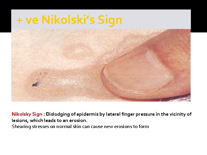+ ve Nikolski’s Sign Nikolsky Sign : Dislodging of epidermis by lateral finger pressure