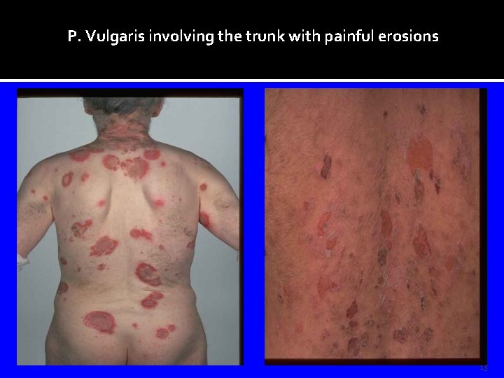 P. Vulgaris involving the trunk with painful erosions 15 