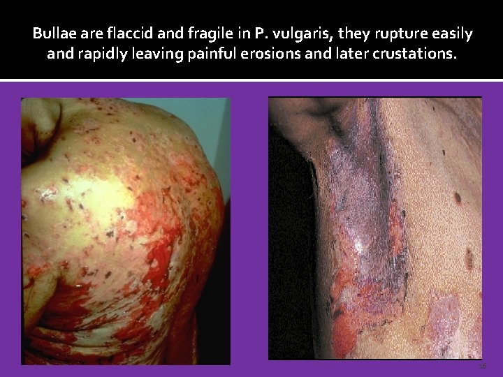 Bullae are flaccid and fragile in P. vulgaris, they rupture easily and rapidly leaving