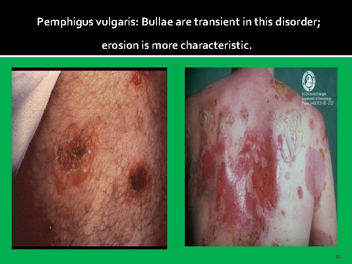 Pemphigus vulgaris: Bullae are transient in this disorder; erosion is more characteristic. 17 
