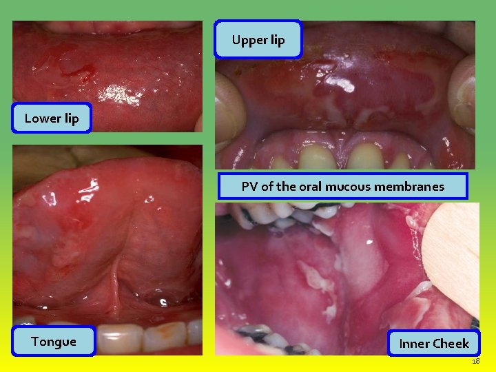 Upper lip Lower lip PV of the oral mucous membranes Tongue Inner Cheek 18