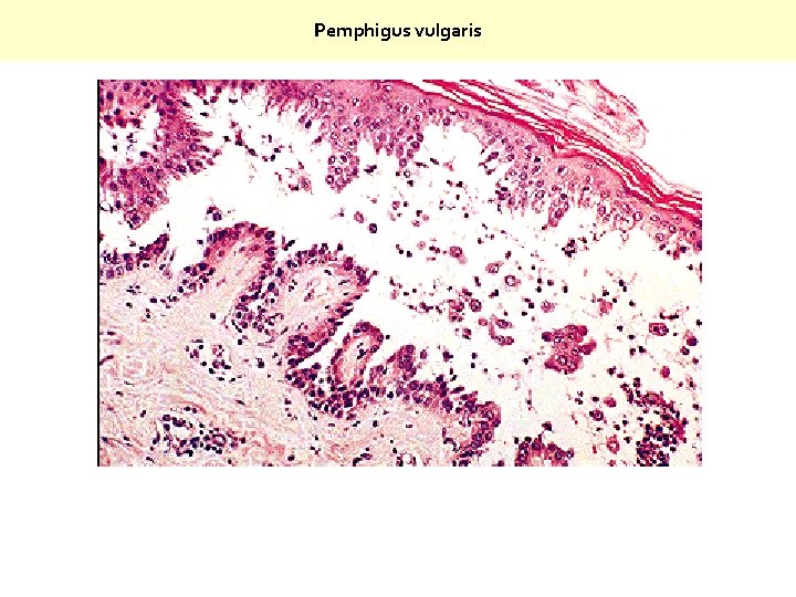Pemphigus vulgaris Suprabasal acantholysis results in an intraepidermal blister containing rounded keratinocytes that are