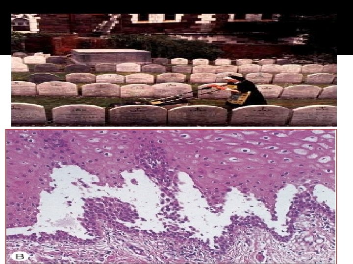 Binding of Abs to the adhesion molecules loss of cell -cell adhesion acantholysis 