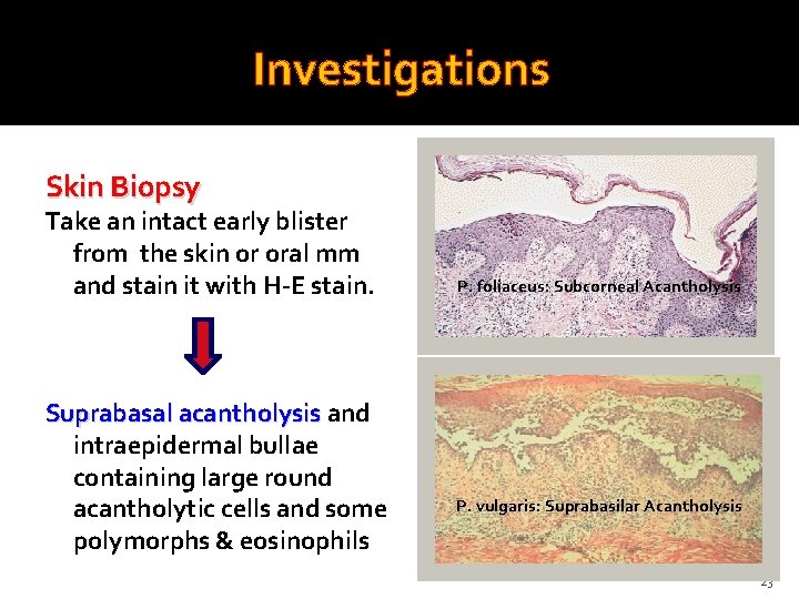 Investigations Skin Biopsy Take an intact early blister from the skin or oral mm