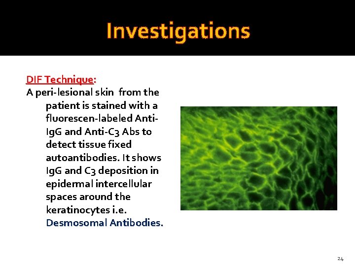 Investigations DIF Technique: A peri-lesional skin from the patient is stained with a fluorescen-labeled