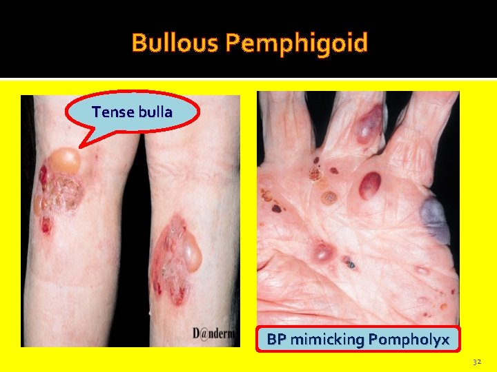 Bullous Pemphigoid Tense bulla BP mimicking Pompholyx 32 