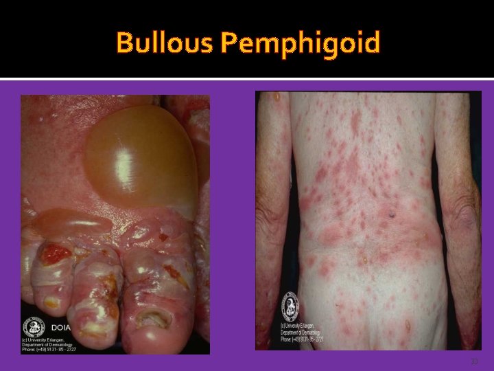 Bullous Pemphigoid 33 