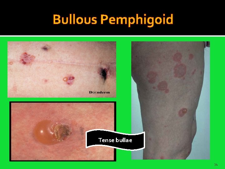 Bullous Pemphigoid Tense bullae 34 
