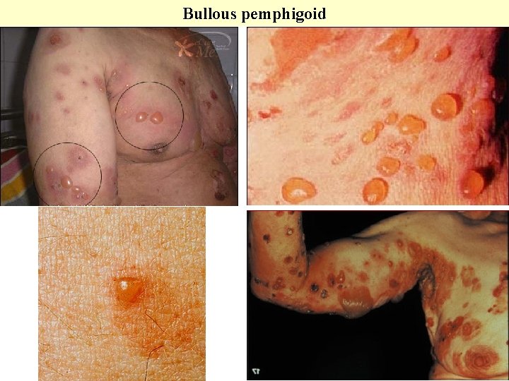 Bullous pemphigoid 