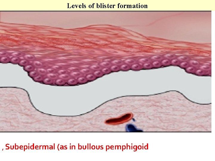 Levels of blister formation A, these lesions. , Subepidermal (as in bullous pemphigoid 