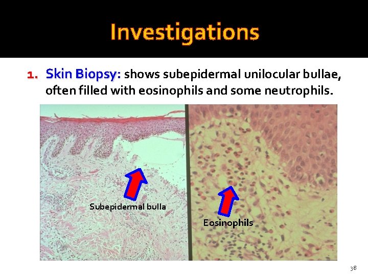 Investigations 1. Skin Biopsy: Biopsy shows subepidermal unilocular bullae, often filled with eosinophils and