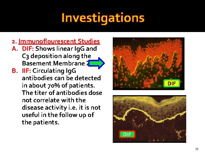 Investigations 2. Immunoflourescent Studies A. DIF: Shows linear Ig. G and C 3 deposition