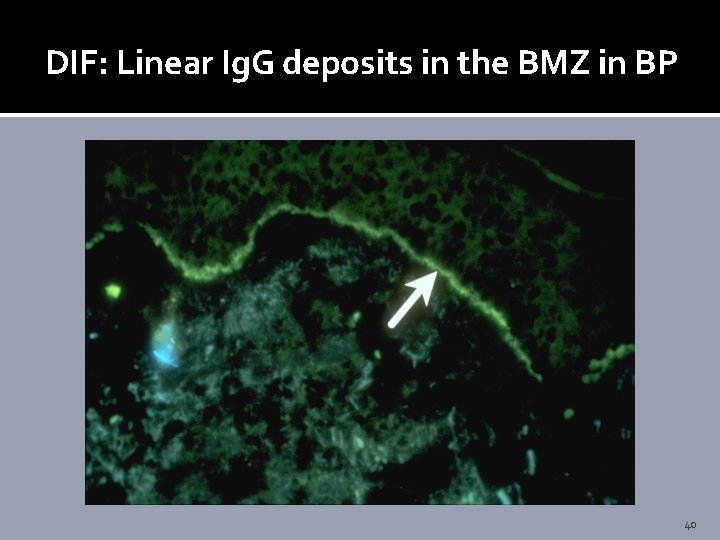 DIF: Linear Ig. G deposits in the BMZ in BP 40 