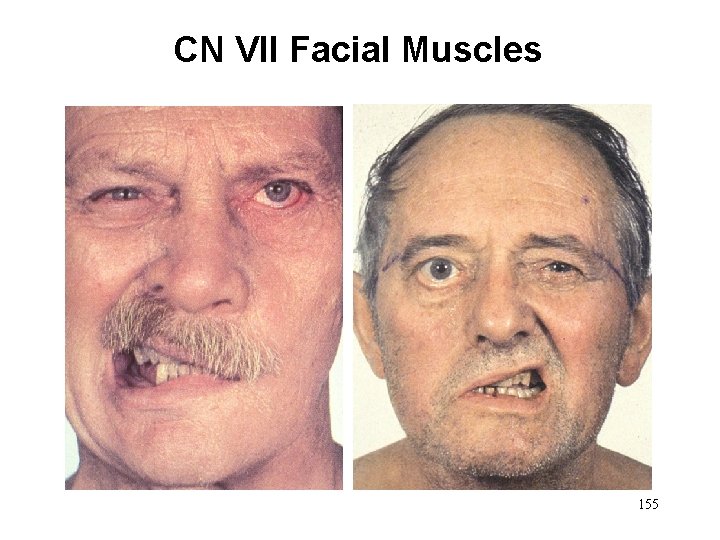 CN VII Facial Muscles 155 