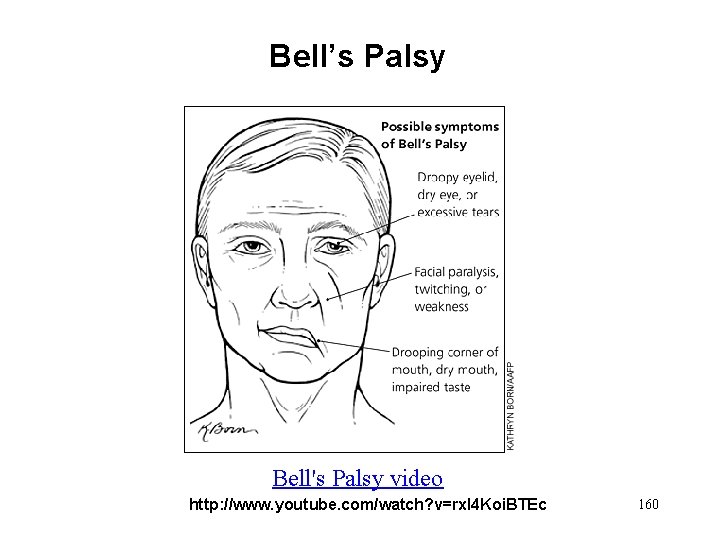 Bell’s Palsy Bell's Palsy video http: //www. youtube. com/watch? v=rxl 4 Koi. BTEc 160