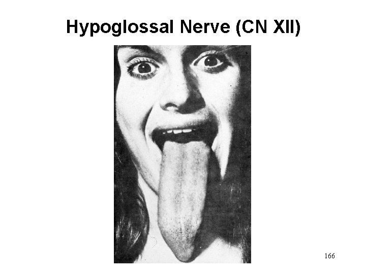 Hypoglossal Nerve (CN XII) 166 
