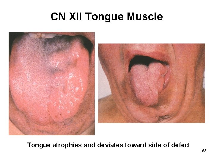 CN XII Tongue Muscle Tongue atrophies and deviates toward side of defect 168 