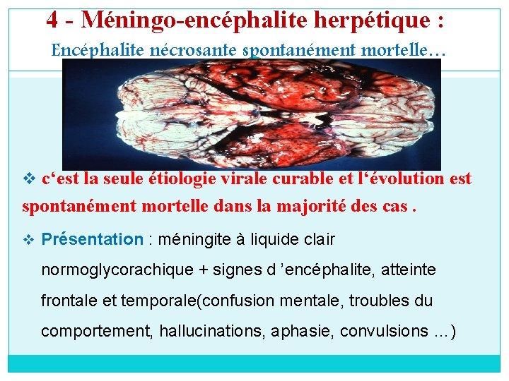 4 - Méningo-encéphalite herpétique : Encéphalite nécrosante spontanément mortelle… v c‘est la seule étiologie