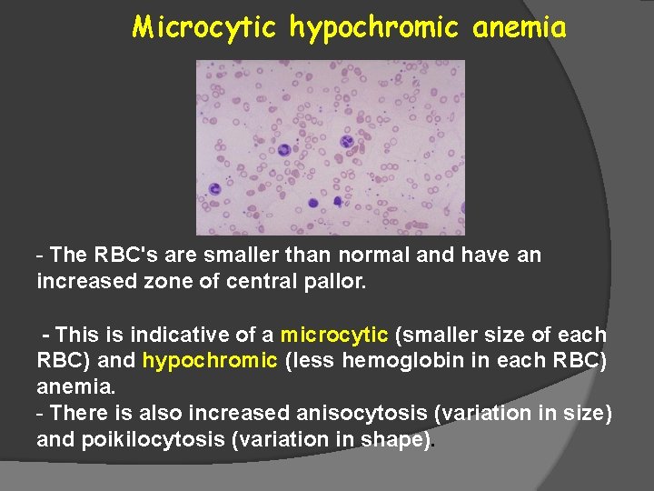 Microcytic hypochromic anemia - The RBC's are smaller than normal and have an increased