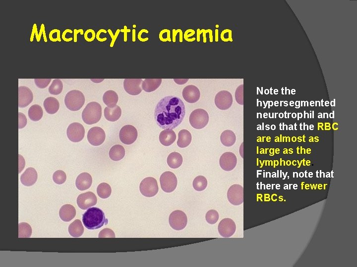 Macrocytic anemia Note the hypersegmented neurotrophil and also that the RBC are almost as