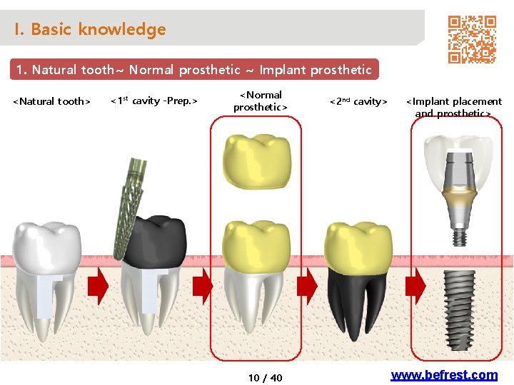 I. Basic knowledge 1. Natural tooth~ Normal prosthetic ~ Implant prosthetic <Natural tooth> <1