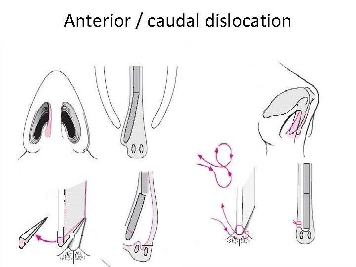 Anterior / caudal dislocation 
