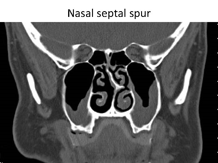 Nasal septal spur 