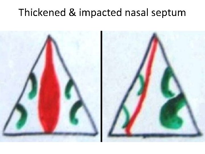 Thickened & impacted nasal septum 