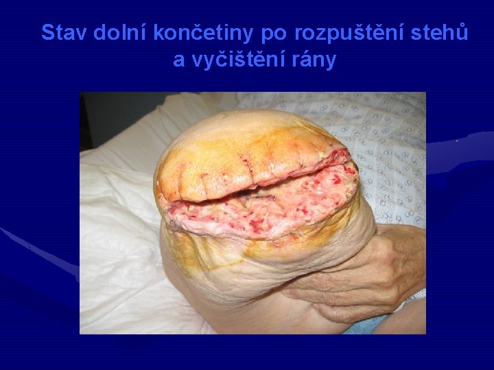 Stav dolní končetiny po rozpuštění stehů a vyčištění rány 