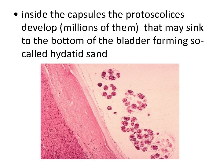 • inside the capsules the protoscolices develop (millions of them) that may sink • inside the capsules the protoscolices develop (millions of them) that may sink