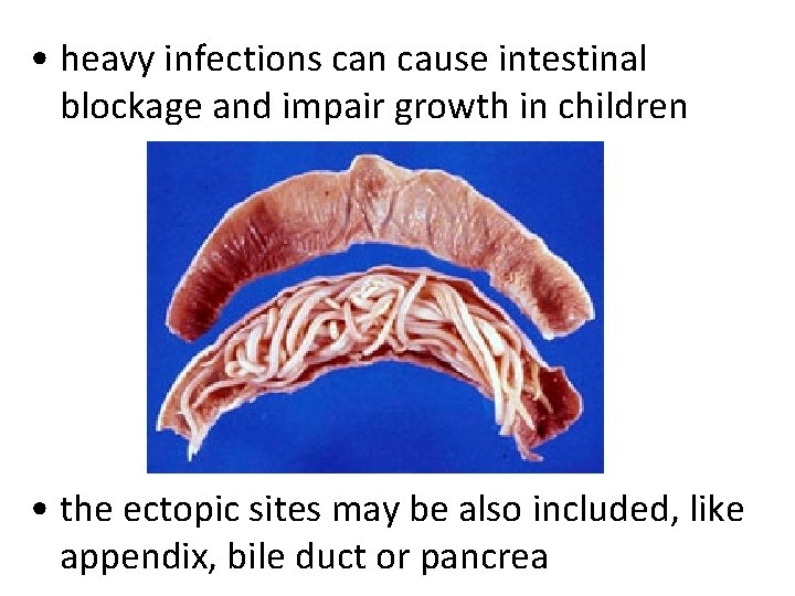 • heavy infections can cause intestinal blockage and impair growth in children • • heavy infections can cause intestinal blockage and impair growth in children •