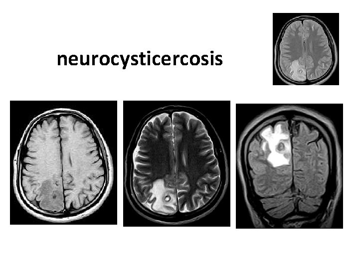 neurocysticercosis neurocysticercosis