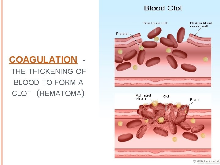COAGULATION - THE THICKENING OF BLOOD TO FORM A CLOT (HEMATOMA) 
